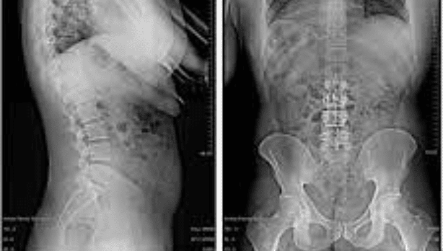 Image for Full Spine Imaging- 2 views